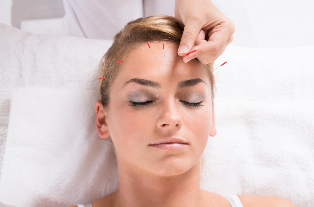 Cosmetic Facial Acupuncture